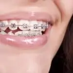 girl wearing braces